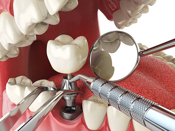 Best Emergency Dentist for Lost Fillings or Crowns in Green Knoll, NJ